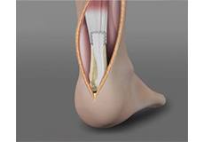 Achilles Tendon Repair