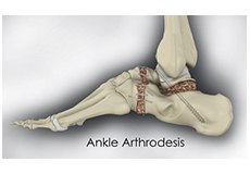 Ankle Arthrodesis