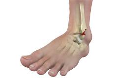 Ankle Instability