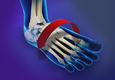 Ankle Instability Surgery