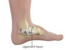 Ankle Ligament Reconstruction