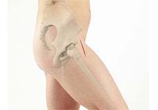 Anterior Hip Replacement