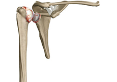 Arthritis of the Shoulder