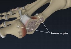 Bunion Surgery or Bunionectomy