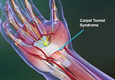 Carpal Tunnel Syndrome