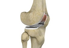 Chondral (Articular Cartilage Defects)