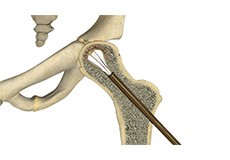 Core Decompression for Avascular Necrosis of the Hip 