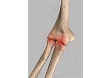 Elbow Arthritis