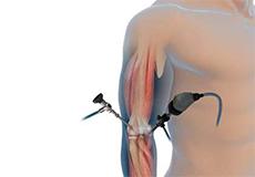 Elbow Arthroscopy