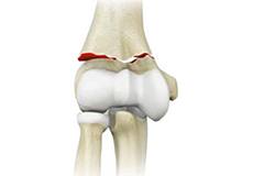 Elbow Fractures