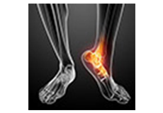 Ankle Tenotomy