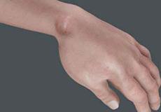 Ganglion Cyst