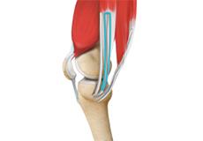 ACL Reconstruction Procedure – Hamstring Tendon 