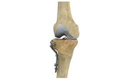 High Tibial Osteotomy