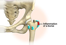 Hip Bursitis