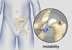 Hip Instability