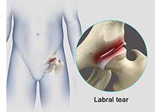 Hip Labral Tear