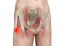 Hip Tendonitis