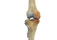 Knee Osteotomy