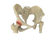 Osteoarthritis of
                                                the Hip