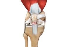 Patella Tendon Rupture