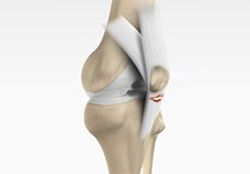 ACL Reconstruction Patellar Tendon