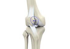 Recurrent Patella Dislocation