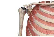 Shoulder Joint Replacement