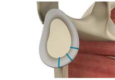 Shoulder Labrum Reconstruction