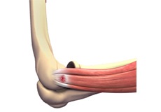 Tennis Elbow Surgery