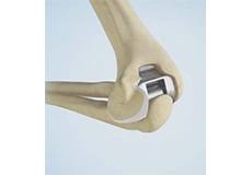 Total Elbow Replacement
