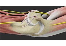 UCL Reconstruction 