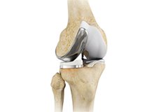 Unicompartmental Knee Replacement