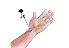 Wrist Arthroscopy