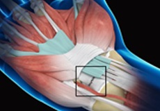 Wrist Ligament Reconstruction